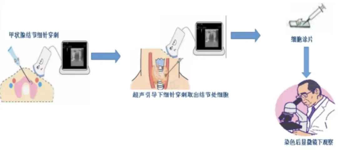 甲状腺FNA.jpg